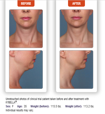 kybella before and after photo