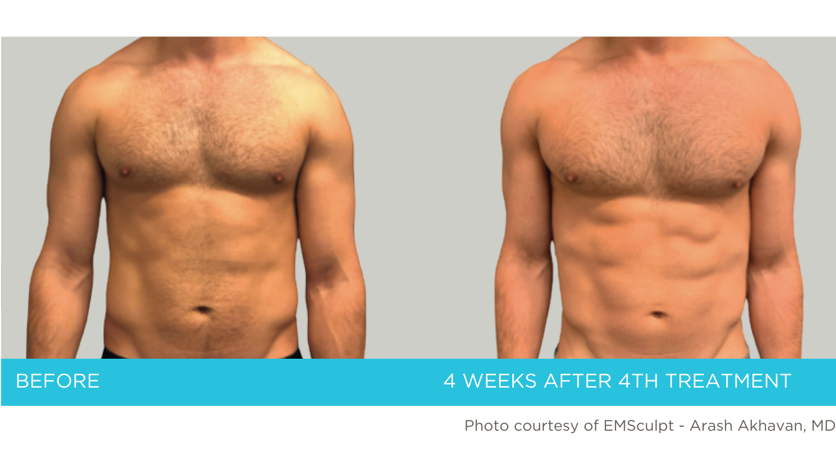 Before and After Emsculpt treatment for muscle toning and sculpting of the abdomen