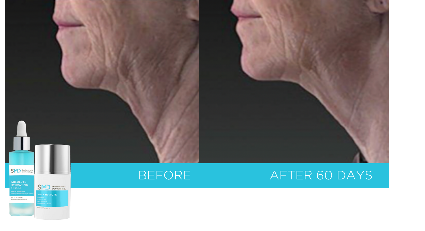 Before and After image of a patient who used the absolute hydrating serum and neck restore products - clinically proven to improve the appearance of fine lines and wrinkles of the neck.