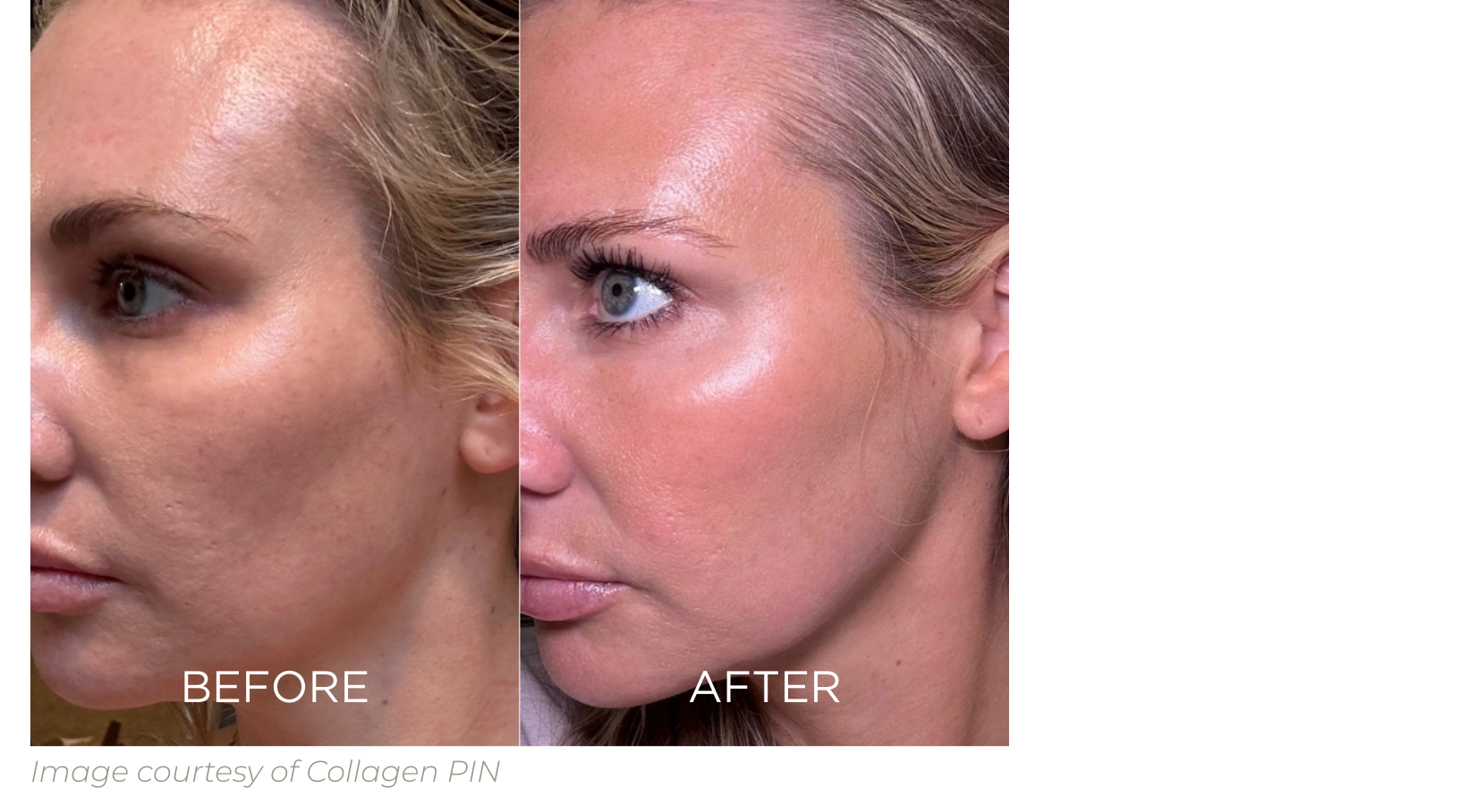 Before & After Image of a woman who underwent microneedling with the Collagen PIN and has significant improvement with skin texture and acne scarring