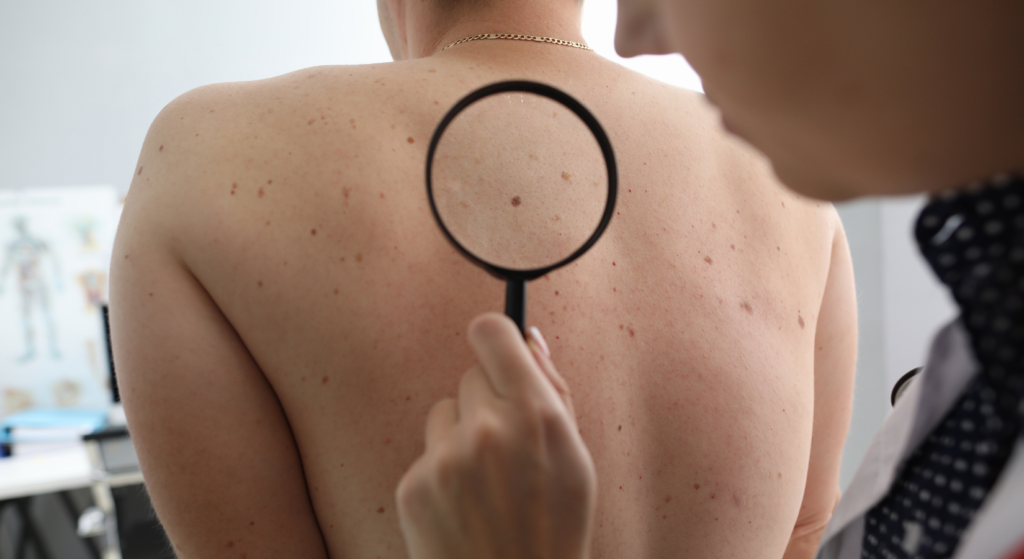 Dermatologist examines moles on a patient's back during an annual full body skin exam.