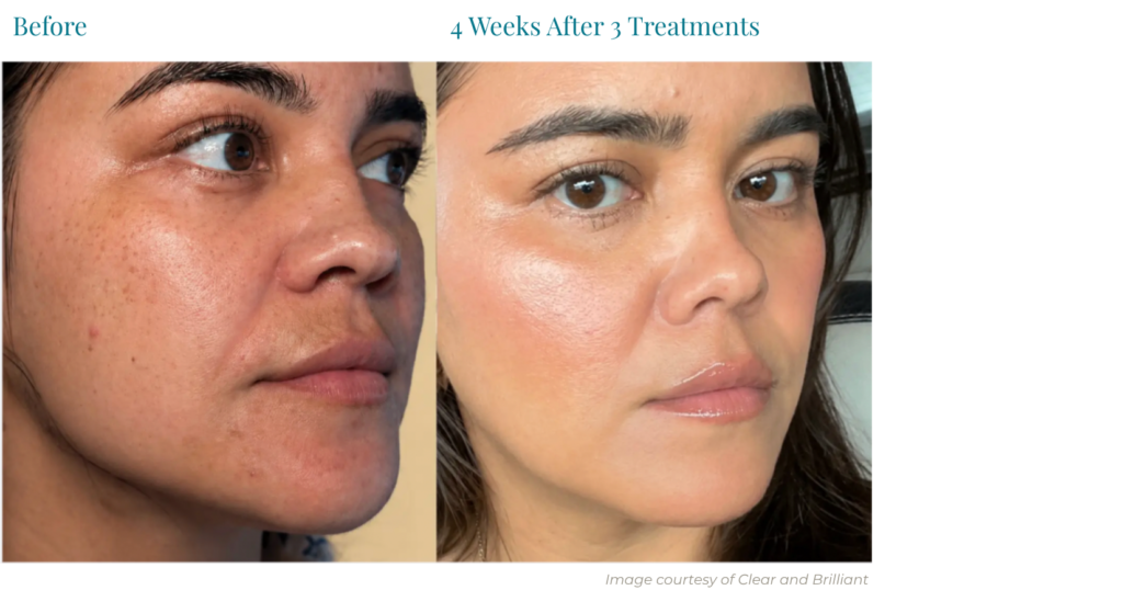Before & After Clear and Brilliant treatment on a patient with olive skin tone