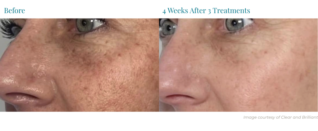 Before and After Clear and Brilliant Touch treatment demonstrating a brighter complexion and reduced dark spots and hyperpigmentation